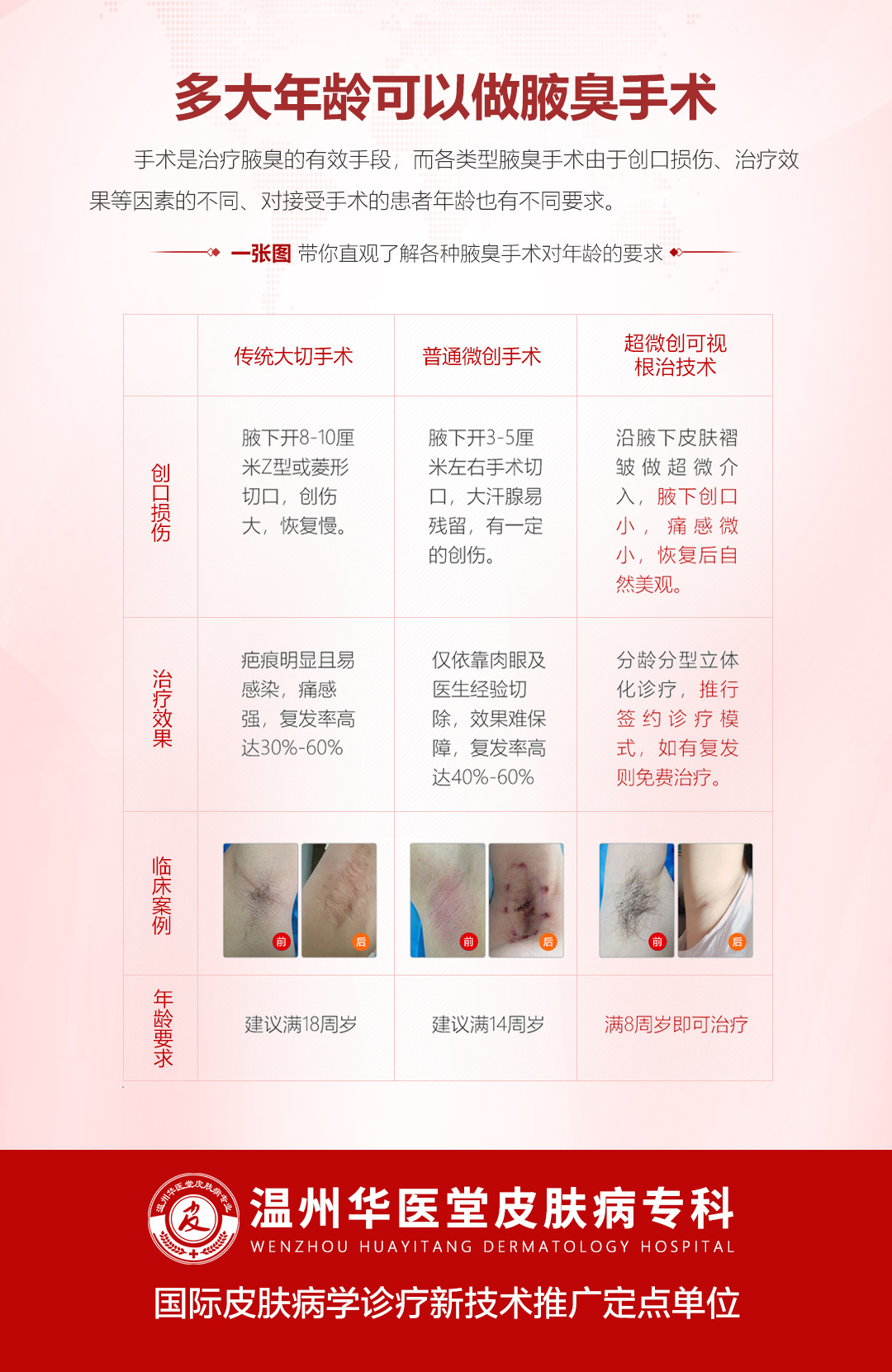 腋臭最新治疗技术与方法探索